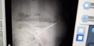 Fue sometido a una operación rutinaria en Maracaibo, le dejaron una tijera en el estómago y murió por una infección