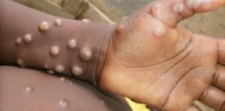 El Reino Unido registra 71 casos de viruela del mono, tras sumar otros 14
