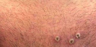 Argentina confirma su primer caso de viruela del mono y estudia sospechoso