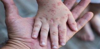 Detectan primer caso de viruela del mono en Suiza