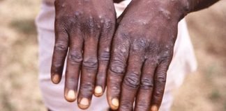 España confirma 21 casos más de viruela no humana y analiza si son del mono