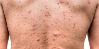 Nueva York acumula mil casos de viruela del mono