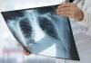 Reportan 11 mil casos de tuberculosis en el país