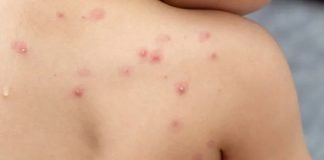 Faltan orientaciones clínicas actualizadas para la viruela del mono