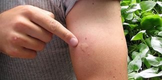 Brote de dengue deja una niña fallecida y 13 menores hospitalizados en Zulia