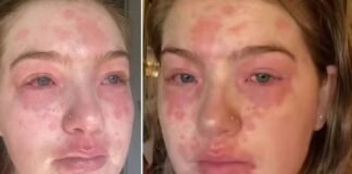 Mujer asegura ser «alérgica a su novio»