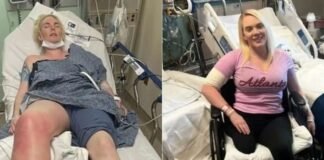 Amputan pierna a modelo tras infectarse con una bacteria agresiva
