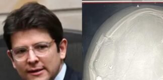 Miguel Uribe Turbay recibió tres disparos, según la Fiscalía de Colombia: Dos de ellos en el cráneo