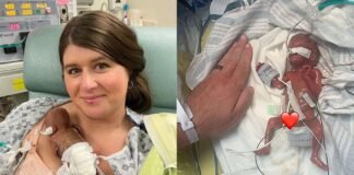 Nace el bebé más prematuro del mundo con solo 21 semanas